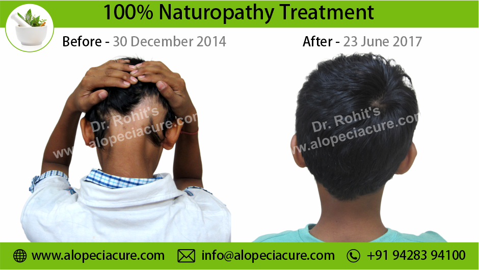 Alopecia Areata Result 6